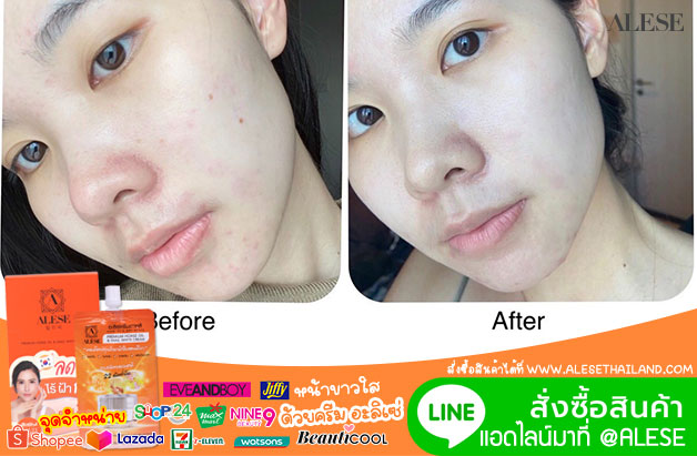 ป้ายยา ครีมซอง Alese Korean Skincare ที่ถูกและดี!